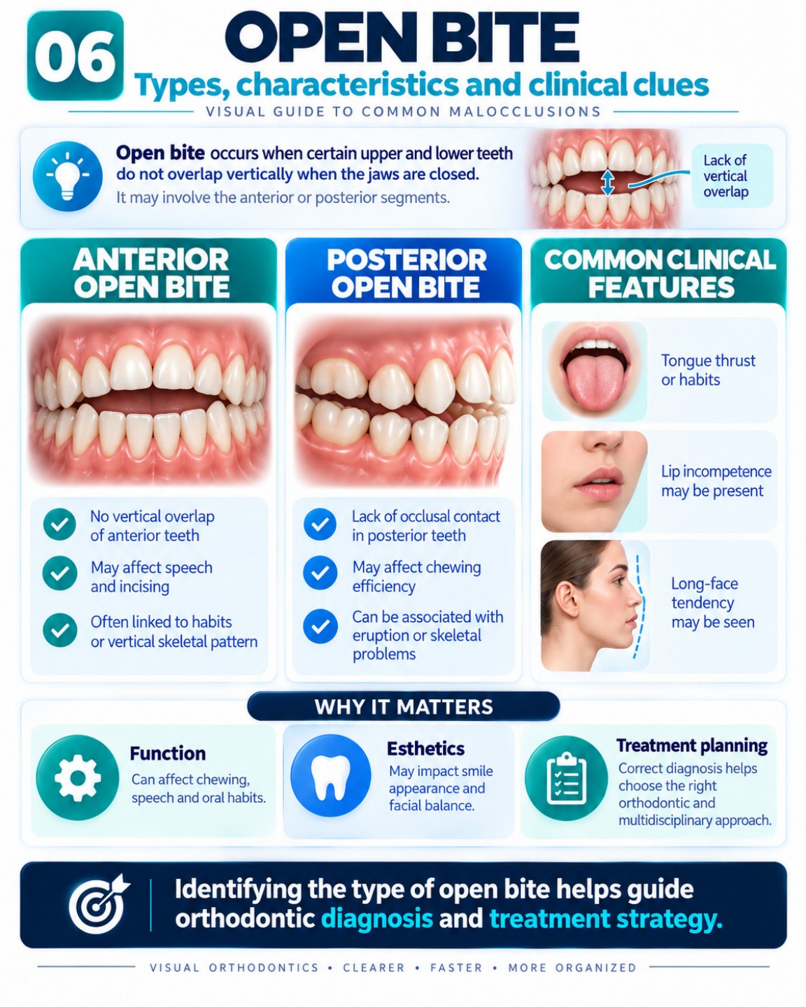 Open Bite